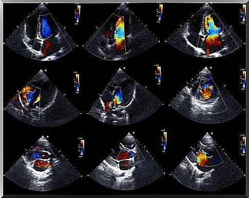 Echocardiogram