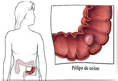 Intestinal Polyps: Symptoms You Should Know