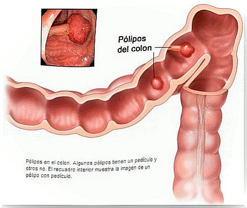 intestinal polyps