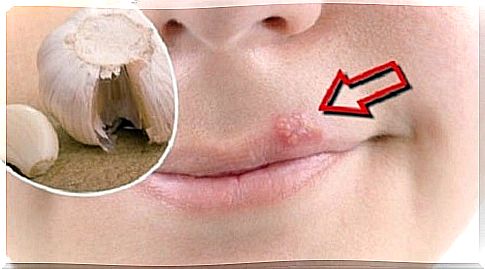 Cold sores know home remedies for quick relief