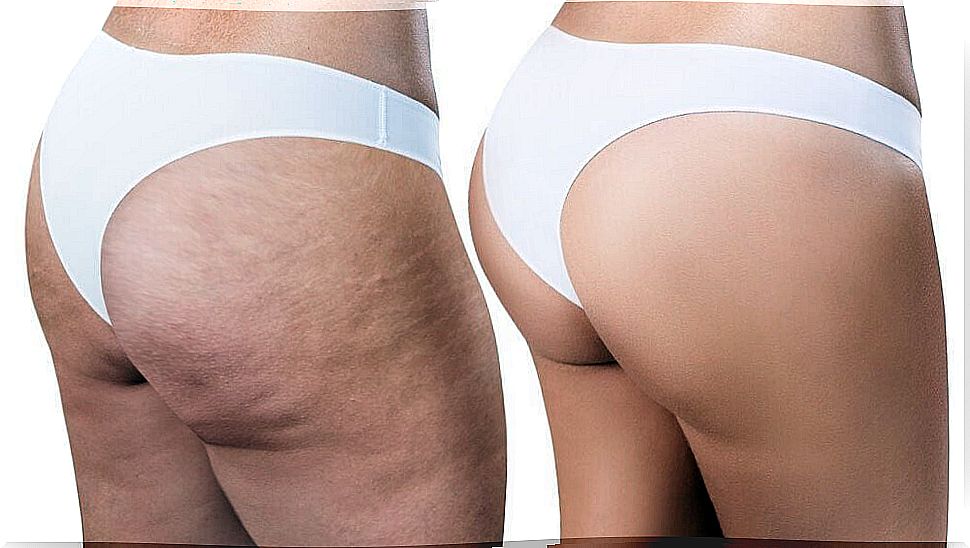 Fight cellulite