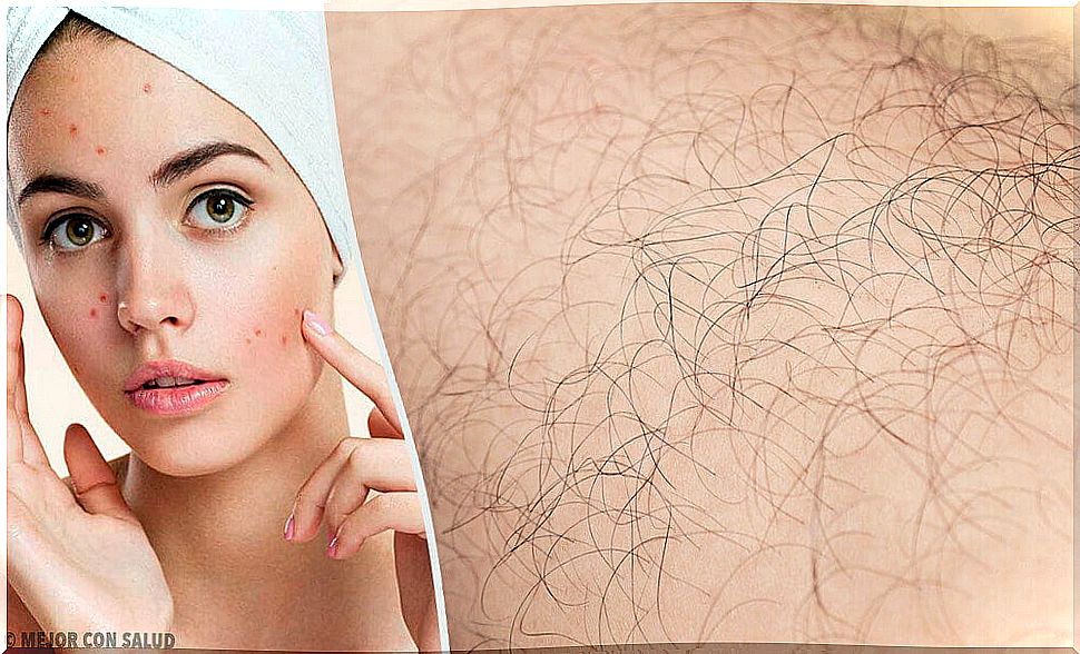 Hirsutism: what it is, causes and natural remedies to treat it