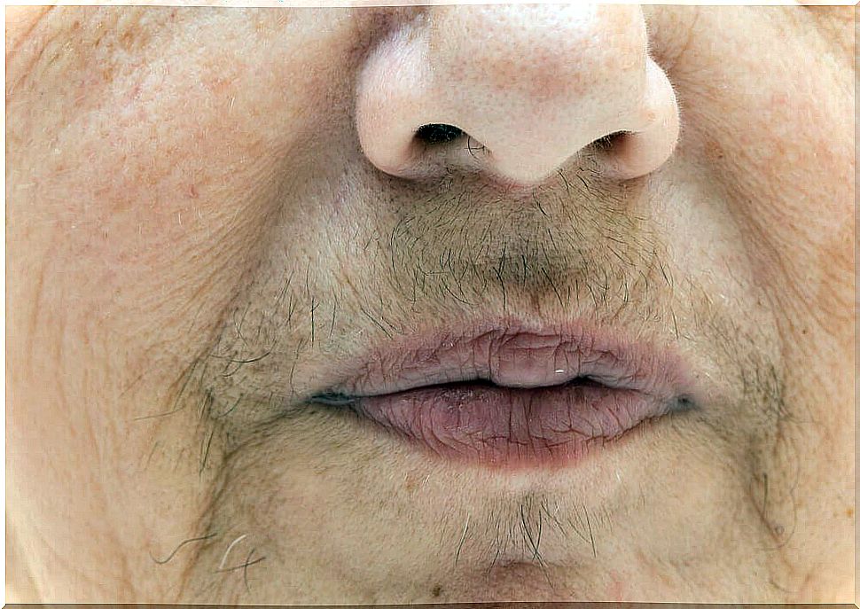 woman with hirsutism