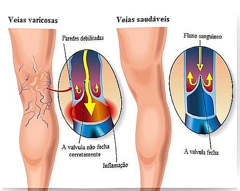 Home treatment for varicose veins