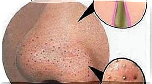 How to eliminate pimples and blackheads naturally?