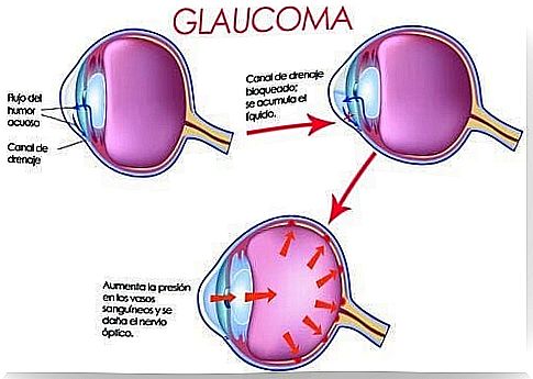 glaucoma eye