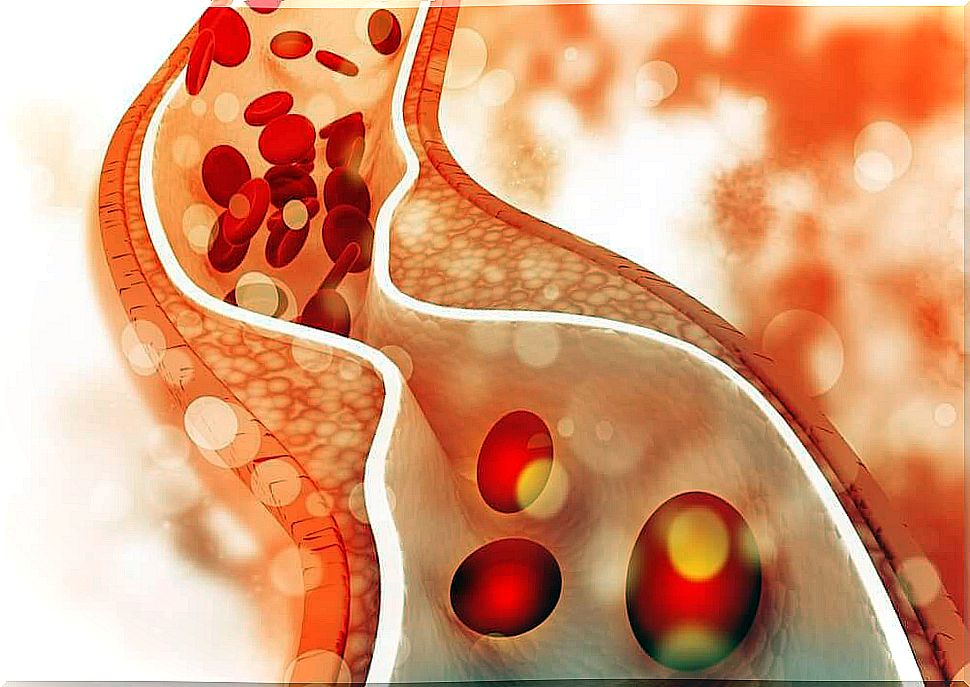 Cholesterol in arteries