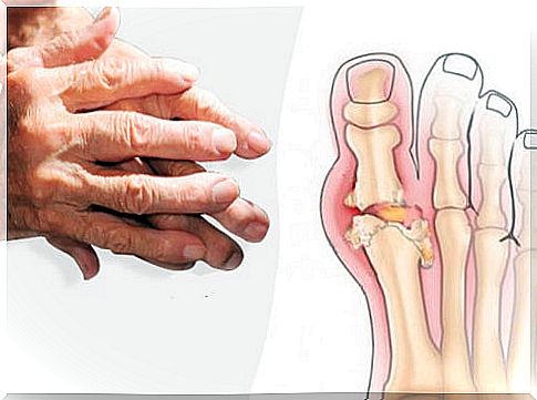 Recommendations for Treating Arthritis