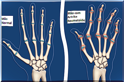 arthritis