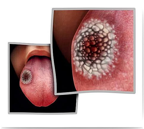 The 5 Possible First Symptoms of Tongue Cancer