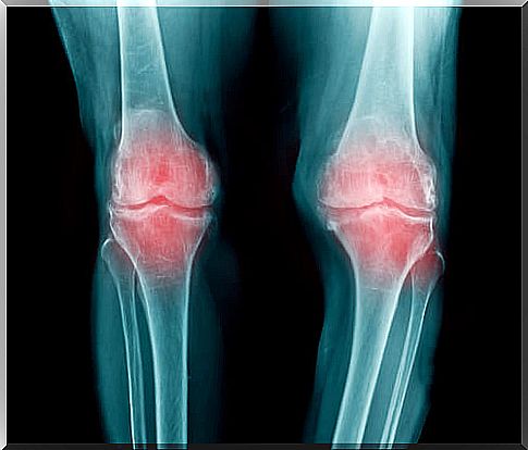 Rheumatoid arthritis in the knees