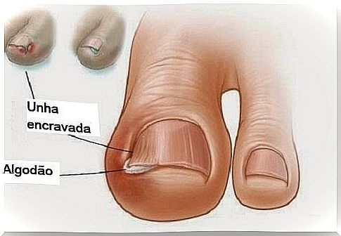 ingrown nails