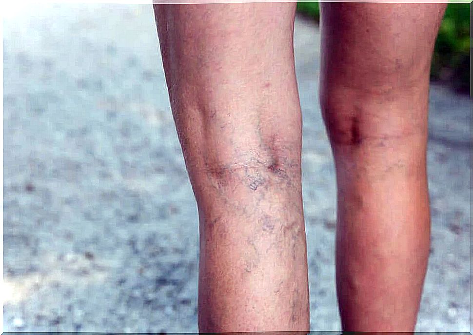 Varicose veins indicate circulation problems