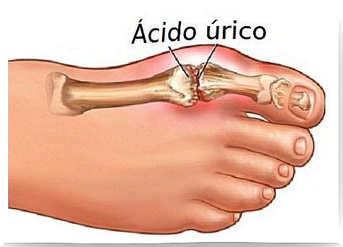 Sign of uric acid in bones