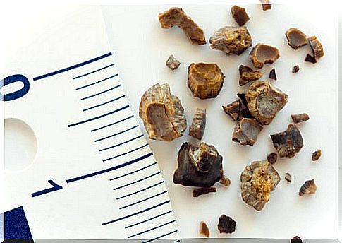 Why do kidney stones form?